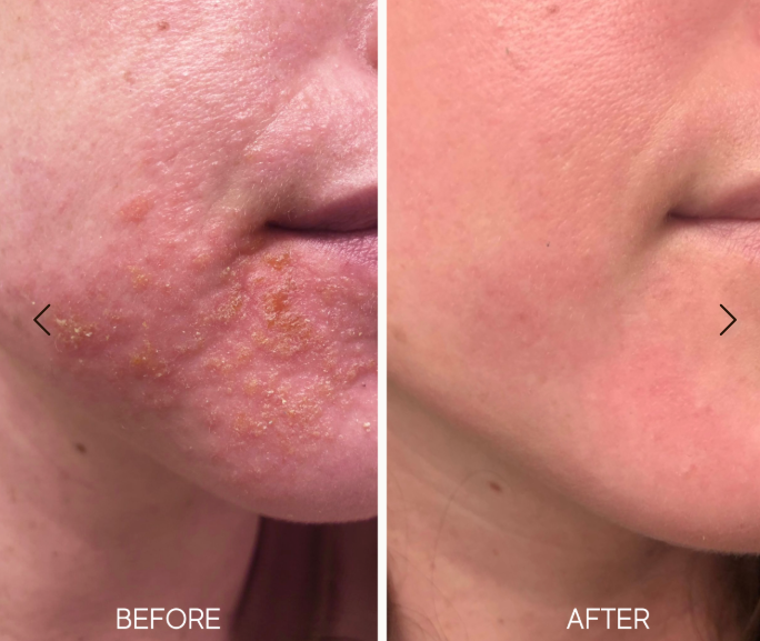 Before and after comparison of skin on a person's face
