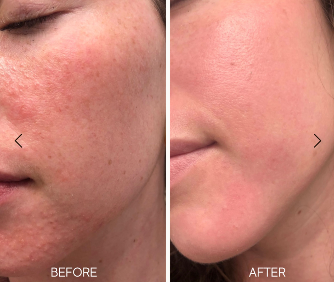 Before and after comparison of skin texture on a person's face.